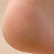 Peau Sèche